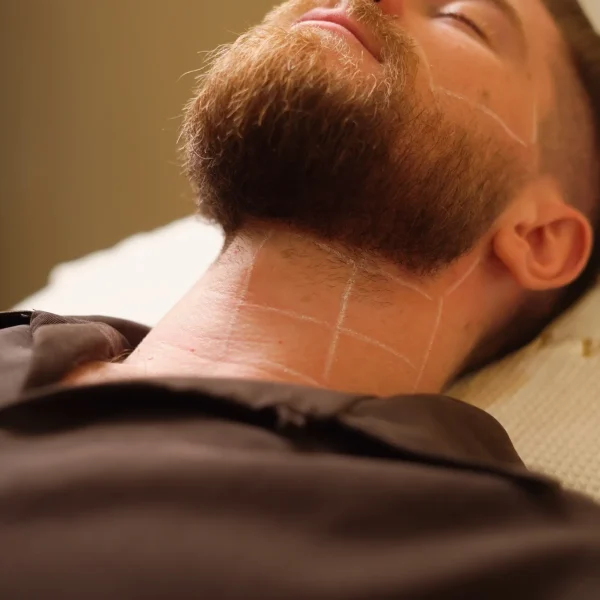 Beard Laser Hair Removal G1