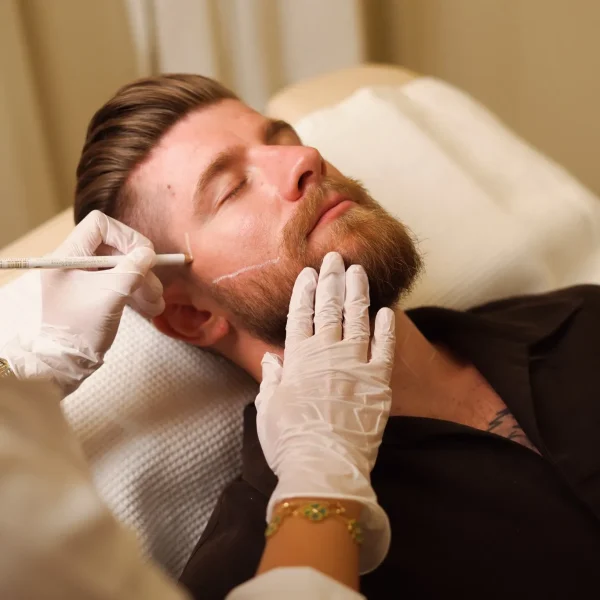 Beard Laser Hair Removal G11