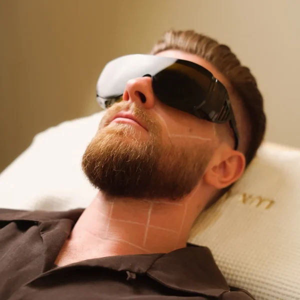 Beard Laser Hair Removal G3