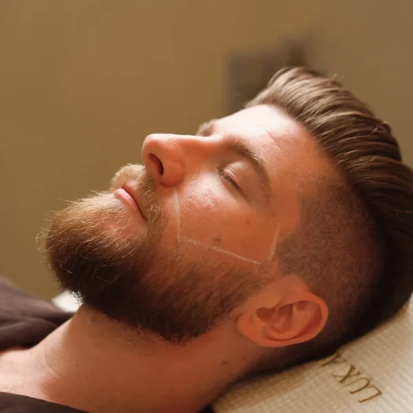 Beard Laser Hair Removal G6