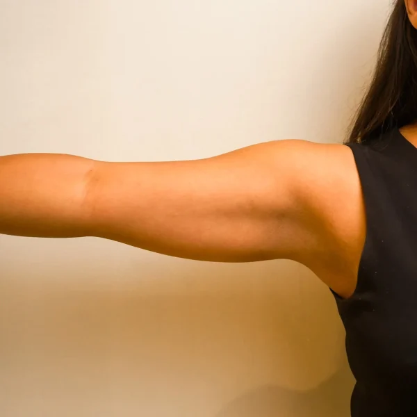 Body Contouring G26