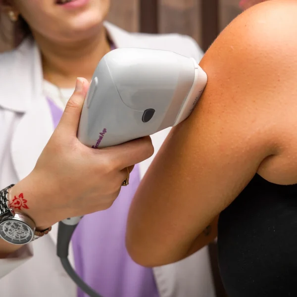 laser hair removal G4