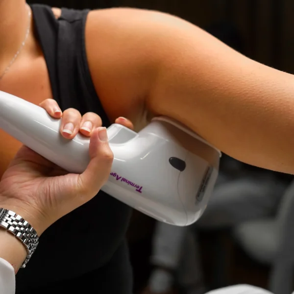 laser hair removal G5