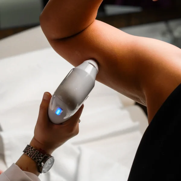 laser hair removal G8
